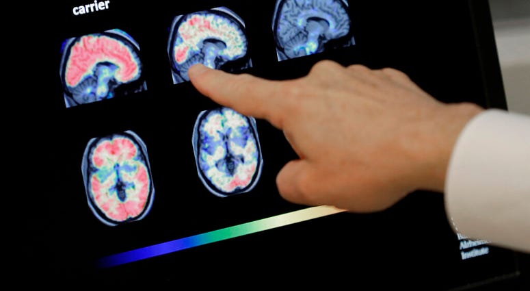 FILE -Dr. William Burke goes over a PET brain scan at Banner Alzheimers Institute in Phoenix. The drug company Biogen Inc. says it will seek federal approval for a medicine to treat early Alzheimer's disease. (AP Photo/Matt York, File) FILE -Dr. William Burke goes over a PET brain scan at Banner Alzheimers Institute in Phoenix. The drug company Biogen Inc. says it will seek federal approval for a medicine to treat early Alzheimer's disease. (AP Photo/Matt York, File)