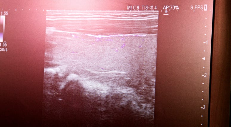 Ultrasound USG monitor.Medical Exam.