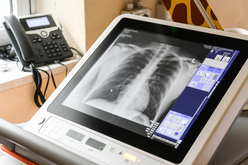 Covid 19 Ling XRay