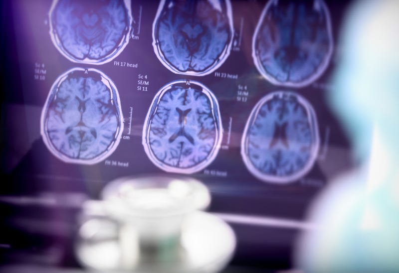 Alzheimer's disease