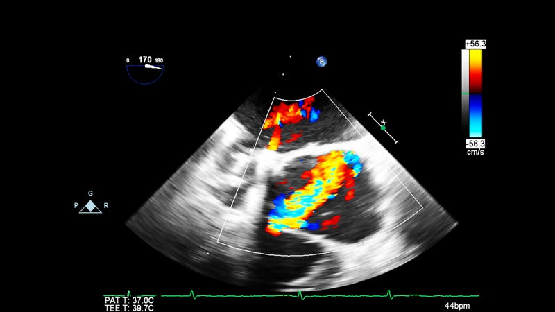 echocardiogram
