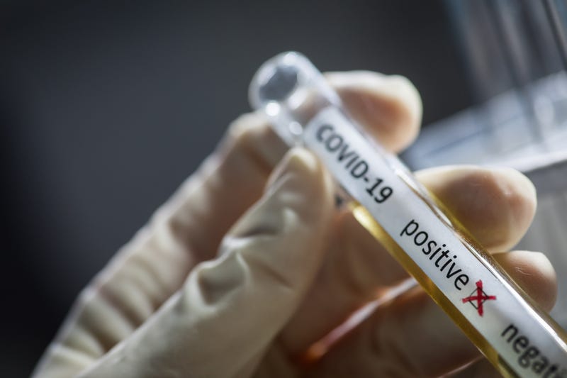 Conceptual photograph of a doctor's hands holding and looking at a test tube while with positive samples for the presence of coronavirus (COVID-19).