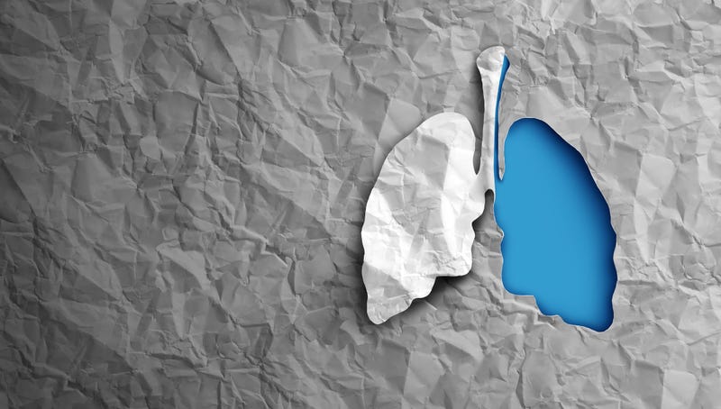 Lung transplant