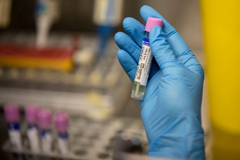 A medical laboratory technician shows a suspected monkeypox sample at the microbiology laboratory of La Paz Hospital on June 06, 2022 in Madrid, Spain.