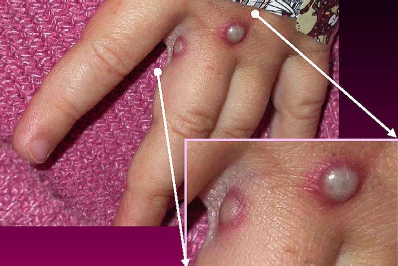 In this Centers for Disease Control and Prevention handout graphic, symptoms of the monkeypox virus are shown on a patient's hand on May 27, 2003. (Photo Courtesy of CDC/Getty Images)