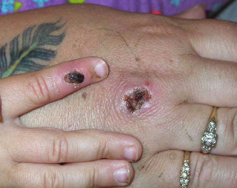Monkeypox lesions on a patient's hand