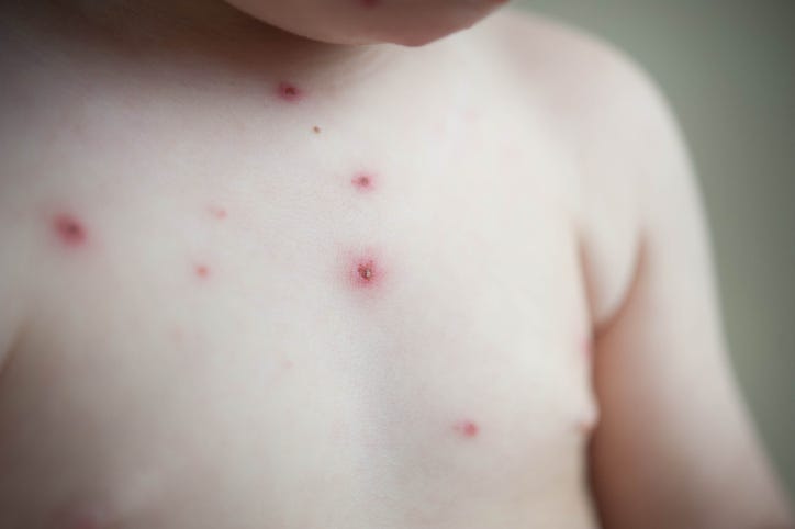 Baby with skin disease