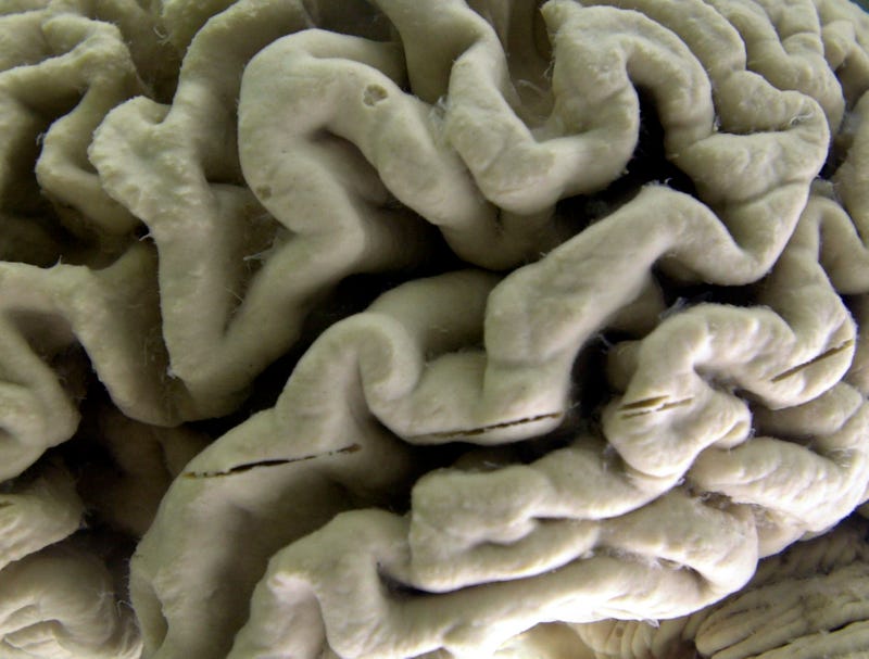 Alzheimer's Drug