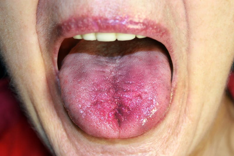 Inflamed tongue