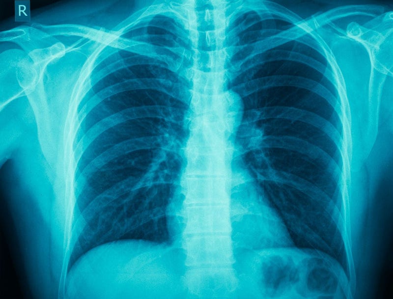 COPD, chronic obstructive pulmonary disease