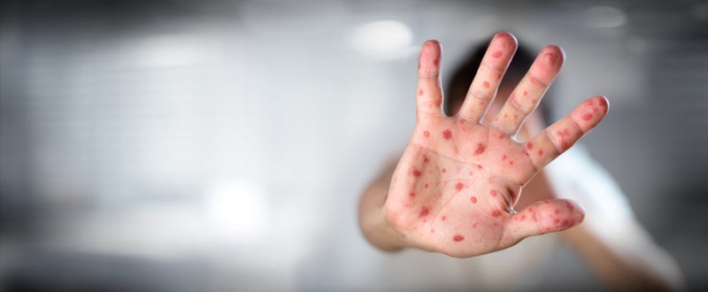 pox