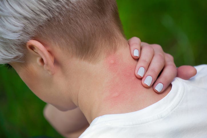 Mosquito bite to the neck