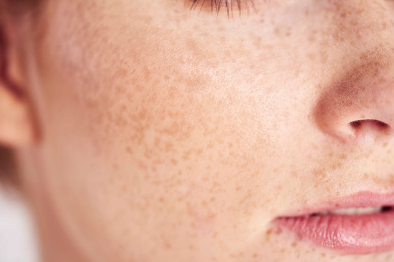 Freckles