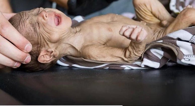 GRM volunteer Katie Batrouney works with a severely malnourished infant. This was a pretty common sight during Mosul since ISIS made serious efforts to control all food and water entering the city.
