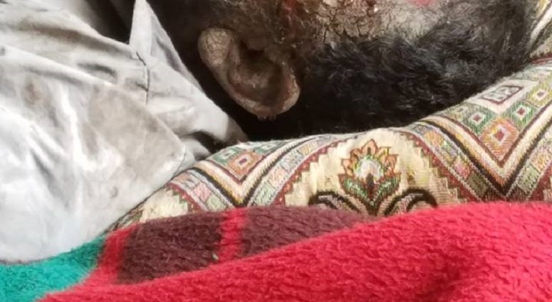 Example of the mustard gas exposure.