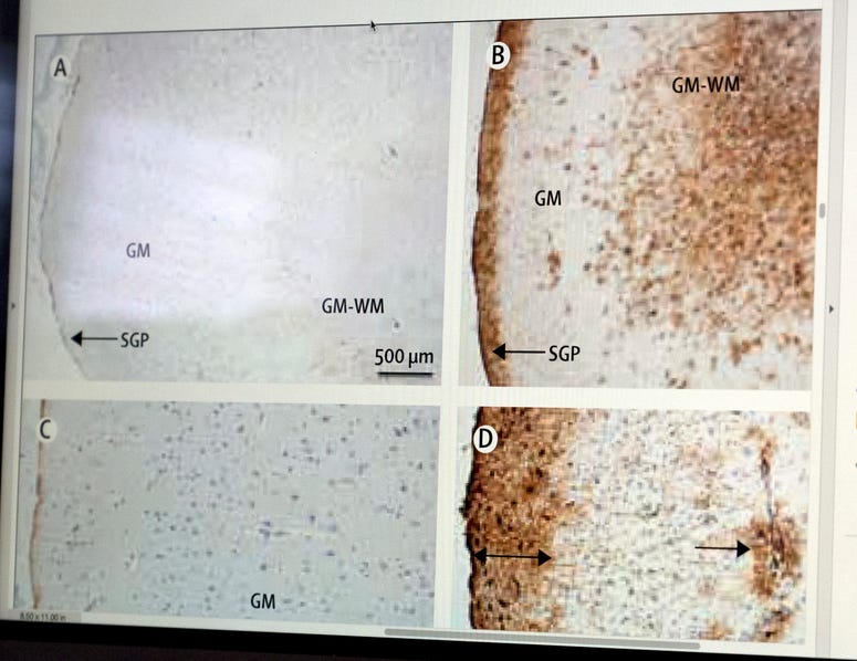 An uninjured brain, left, contrasts with Traumatic Brain Injury, theoretically caused by being near explosive detonations. An uninjured brain, left, contrasts with Traumatic Brain Injury, theoretically caused by being near explosive detonations.
