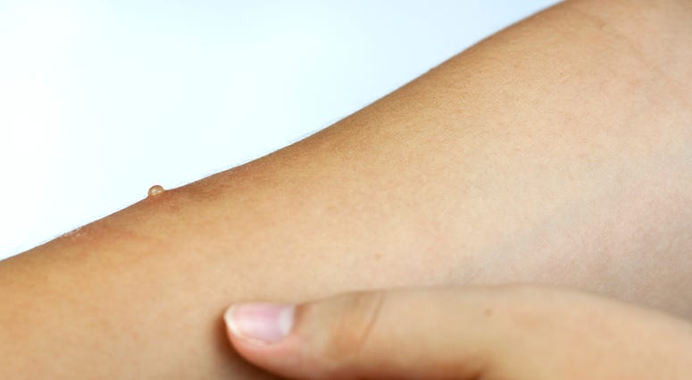 Measles on arm Measles on arm