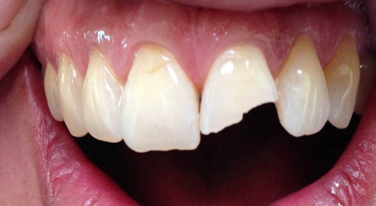 Broken tooth Broken tooth