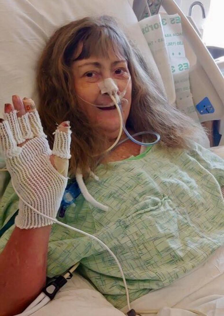 Suzie Ernest and her husband are recovering from severe burns at the UC Davis Medical Center in Sacramento.