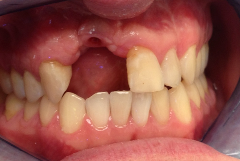 Missing tooth Missing tooth