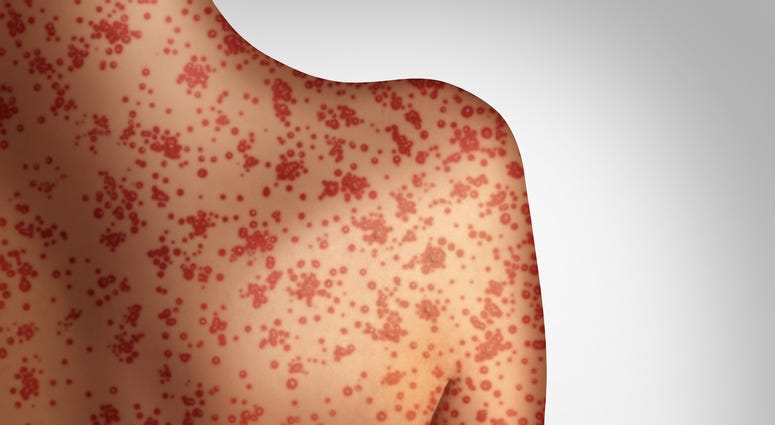 Measles concept as a deadly outbreak immunize,disease and viral illness as a contagious chickenpox or a skin rash in a 3D illustration style. Measles concept as a deadly outbreak immunize,disease and viral illness as a contagious chickenpox or a skin rash in a 3D illustration style.