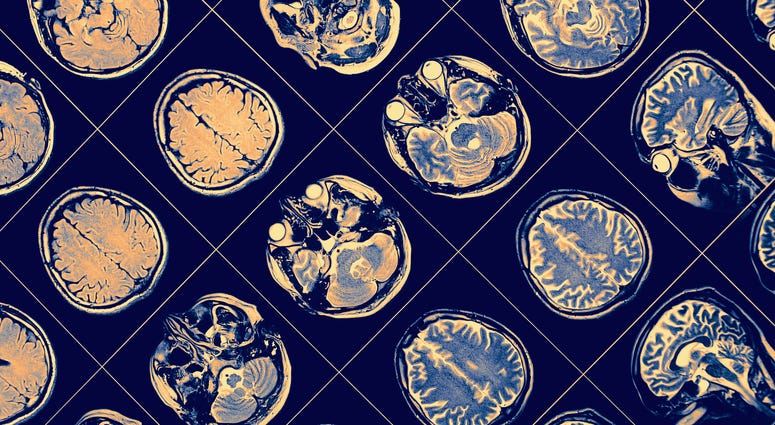 brain scan