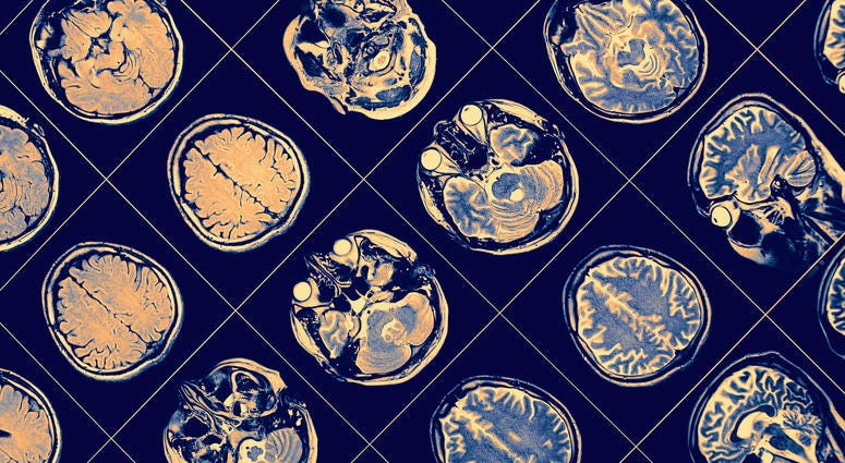 brain scan