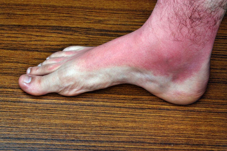Weird Sunburn Weird Sunburn