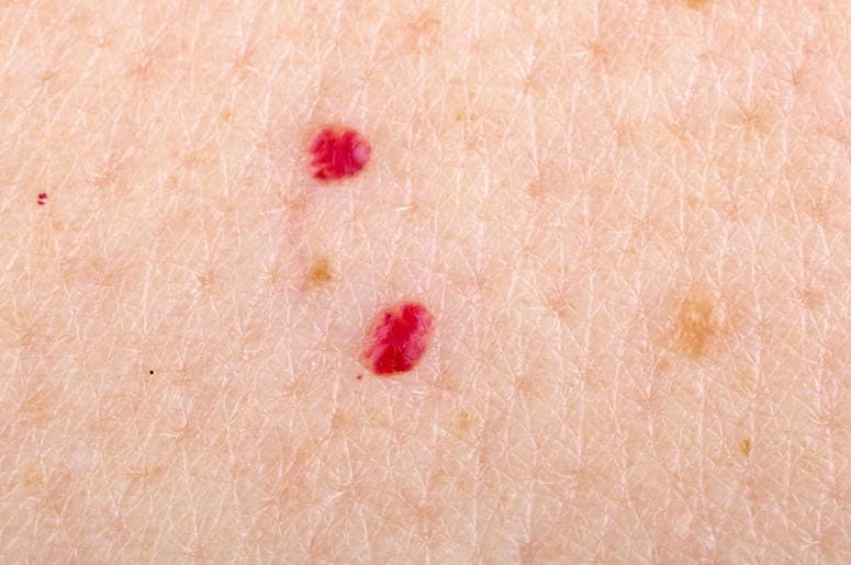 Red Dots, Skin, Blood, Cherry Angioma Red Dots, Skin, Blood, Cherry Angioma