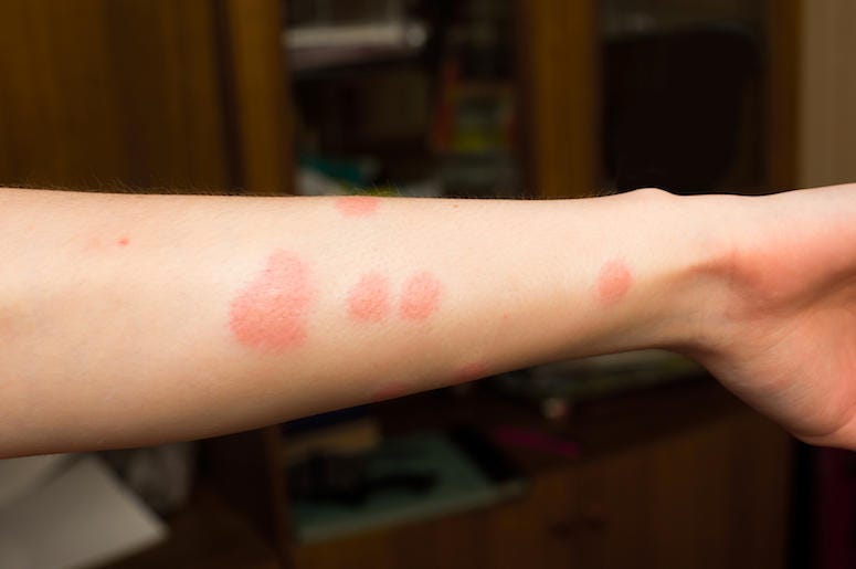 Chigger Bites Chigger Bites