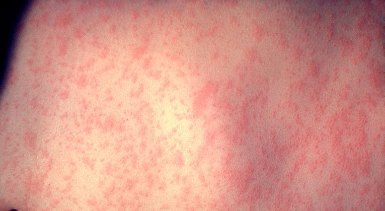 In this handout from the Centers for Disease Control and Prevention (CDC), the skin of a patient after three days of measles infection is seen at a New York hospital in 1958.