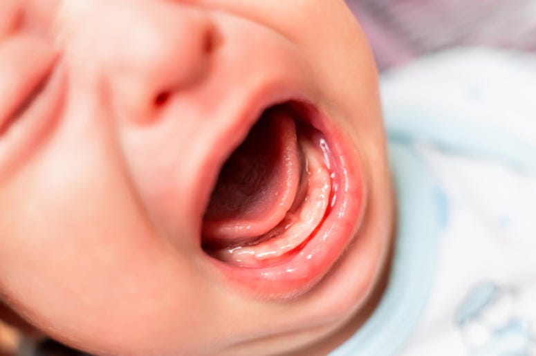 Bebé Recién Nacido Es Abandonado En La Basura En Arlington Close up photo of crying 3 months old baby mouth. Bare gums without teeth.