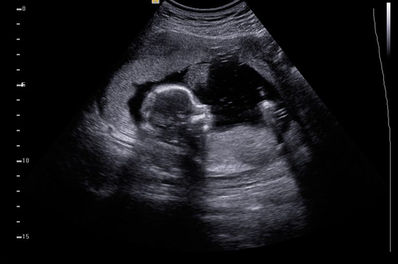 ultrasound ultrasound