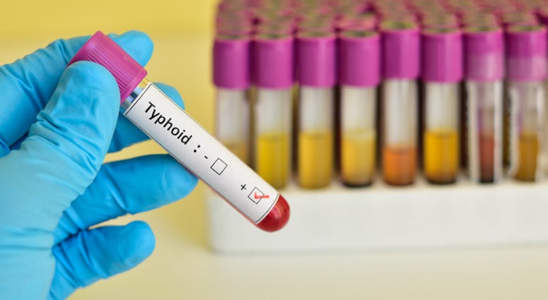 Typhoid blood sample Typhoid blood sample