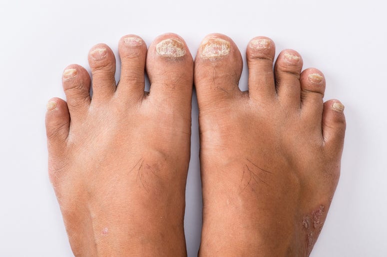 Psoriasis that Pedicure