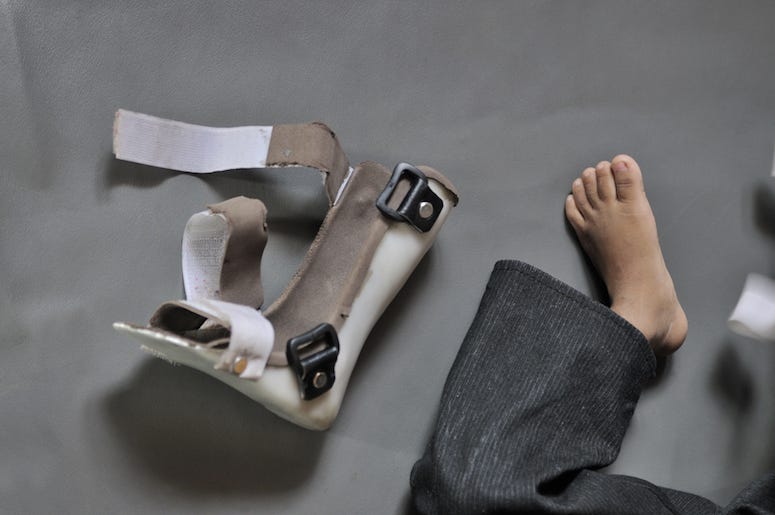 Child, Foot, Cerebral Palsy, Orthopedic Shoe Child, Foot, Cerebral Palsy, Orthopedic Shoe