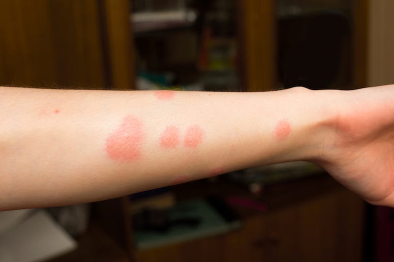 Arm, Bug Bites Arm, Bug Bites