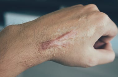 scar