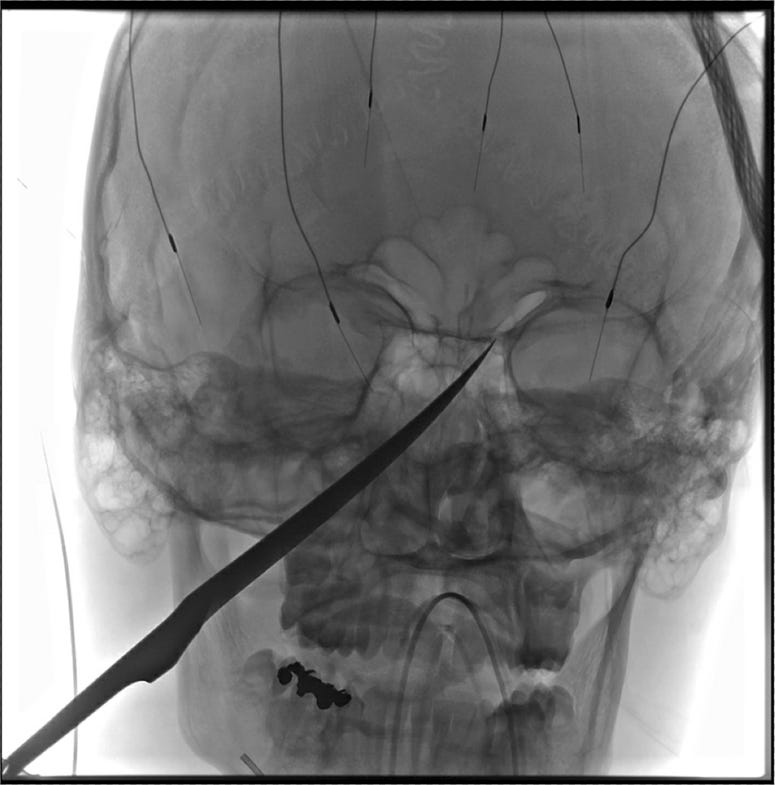 This X-Ray imagery provided by The University of Kansas Health System shows the skull of Eli Gregg with a knife embedded. X-Ray