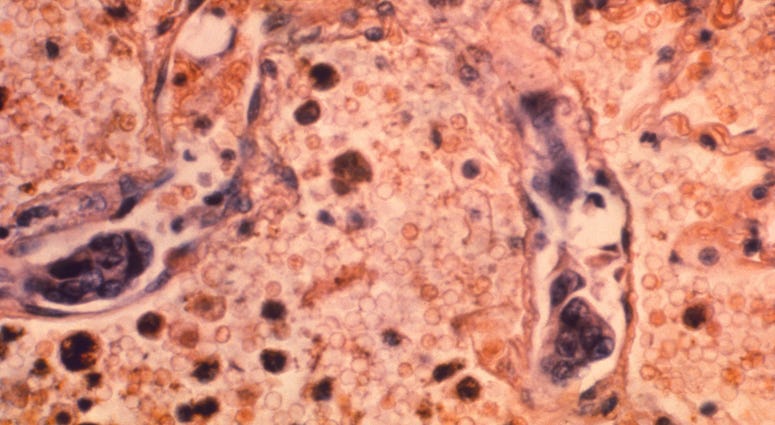 This 1964 photo made available by the Centers for Disease Control and Prevention shows a lung tissue specimen from a patient with adenocarcinoma of the lung. This 1964 photo made available by the Centers for Disease Control and Prevention shows a lung tissue specimen from a patient with adenocarcinoma of the lung.