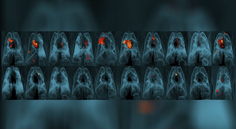 This image provided by the University of Pittsburgh School of Medicine and the National Institute of Allergy and Infectious Diseases shows a collection of lung scans of 20 monkeys who were exposed to tuberculosis after receiving different forms of a TB va This image provided by the University of Pittsburgh School of Medicine and the National Institute of Allergy and Infectious Diseases shows a collection of lung scans of 20 monkeys who were exposed to tuberculosis after receiving different forms of a TB va