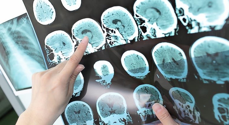 Doctor view output CT scan. brain tumor