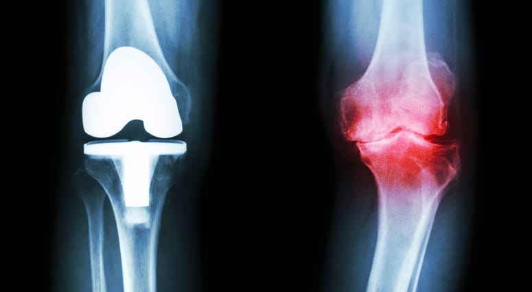 osteoarthritis osteoarthritis