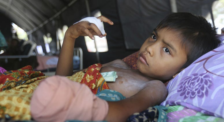In this Wednesday, Oct. 3, 2018, photo, a child recovers after his left hand was amputated after being injured in the massive earthquake in Palu, Central Sulawesi Indonesia. In this Wednesday, Oct. 3, 2018, photo, a child recovers after his left hand was amputated after being injured in the massive earthquake in Palu, Central Sulawesi Indonesia.