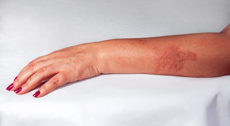 Redness from painful burn on a woman's hand. Redness from painful burn on a woman's hand.
