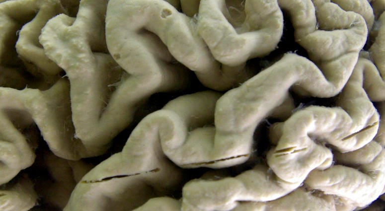 A section of a human brain with Alzheimer's disease on display at the Museum of Neuroanatomy at the University at Buffalo, in Buffalo, N.Y. A section of a human brain with Alzheimer's disease on display at the Museum of Neuroanatomy at the University at Buffalo, in Buffalo, N.Y.