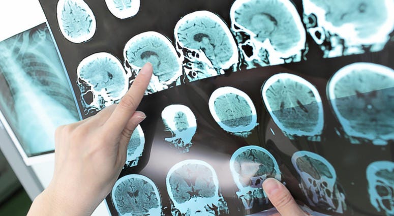 Doctor view output CT scan. brain tumor
