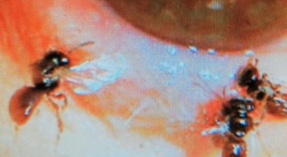 Doctors shared these images of the four tiny sweat bees they found in a woman's eye. Doctors shared these images of the four tiny sweat bees they found in a woman's eye.