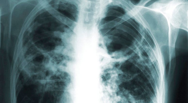 This 1966 image made available by the Centers of Disease Control and Prevention shows a chest x-ray of a tuberculosis patient. This 1966 image made available by the Centers of Disease Control and Prevention shows a chest x-ray of a tuberculosis patient.