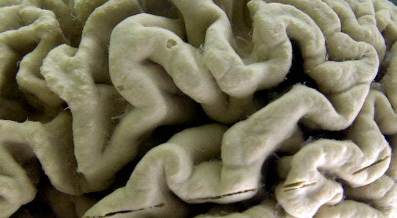 FILE - This Oct. 7, 2003 file photo shows a section of a human brain with Alzheimer's disease on display at the Museum of Neuroanatomy at the University at Buffalo, in Buffalo, N.Y. FILE - This Oct. 7, 2003 file photo shows a section of a human brain with Alzheimer's disease on display at the Museum of Neuroanatomy at the University at Buffalo, in Buffalo, N.Y.